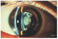 Moderate Cataract